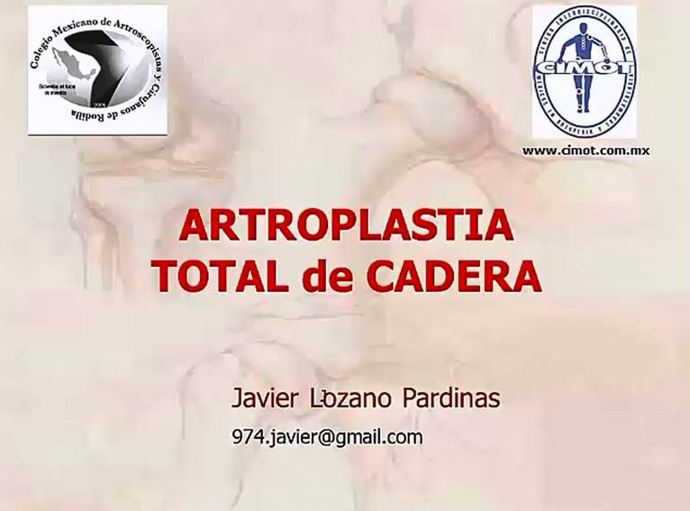 Artroplasta de Cadera